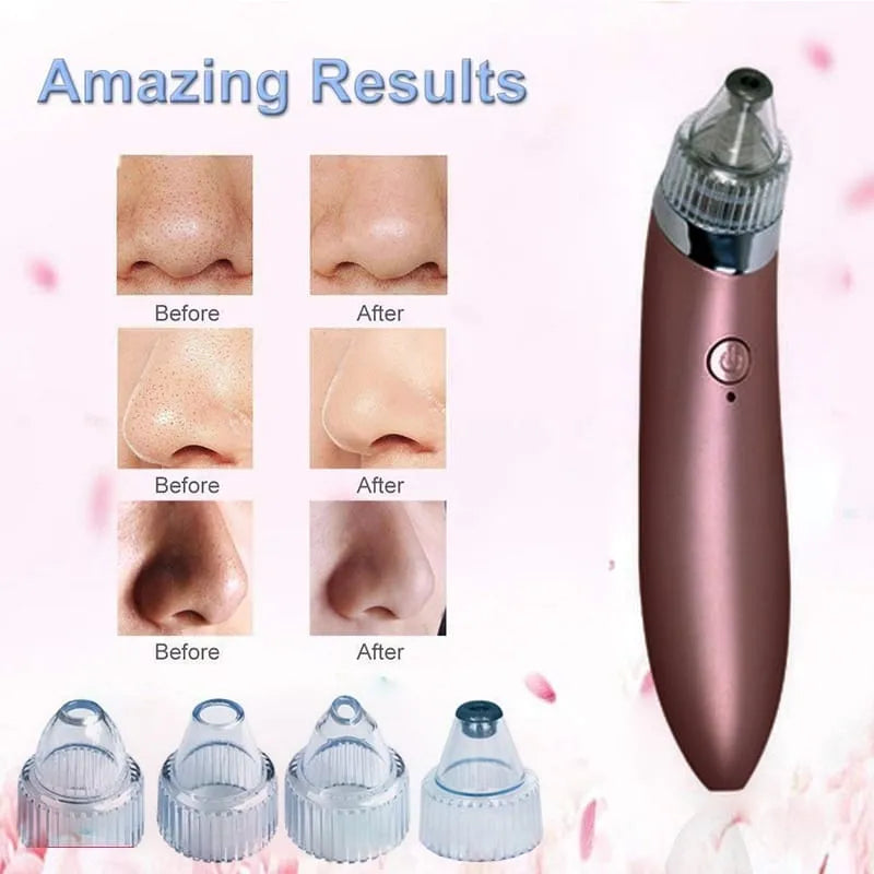 USB rechargeable 5-in-1 blackhead vacuum pore cleaner for home and travel