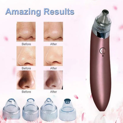 USB rechargeable 5-in-1 blackhead vacuum pore cleaner for home and travel